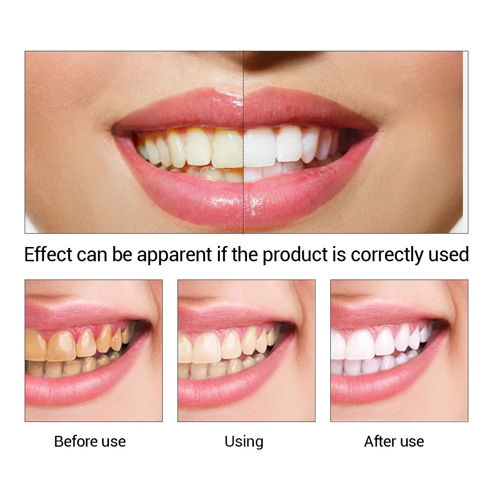 FTEENPLY Teeth Whitening Essen - Teeth Whitening Quotes recension och pris