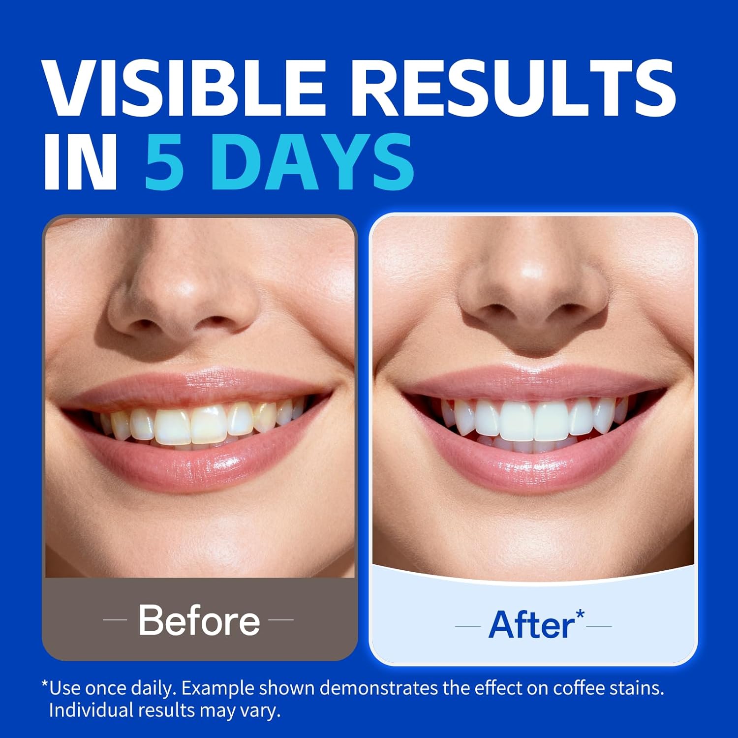1/7 Pairs Teeth Whitening Stri - Teeth Whitening Strips Permanent recension och pris