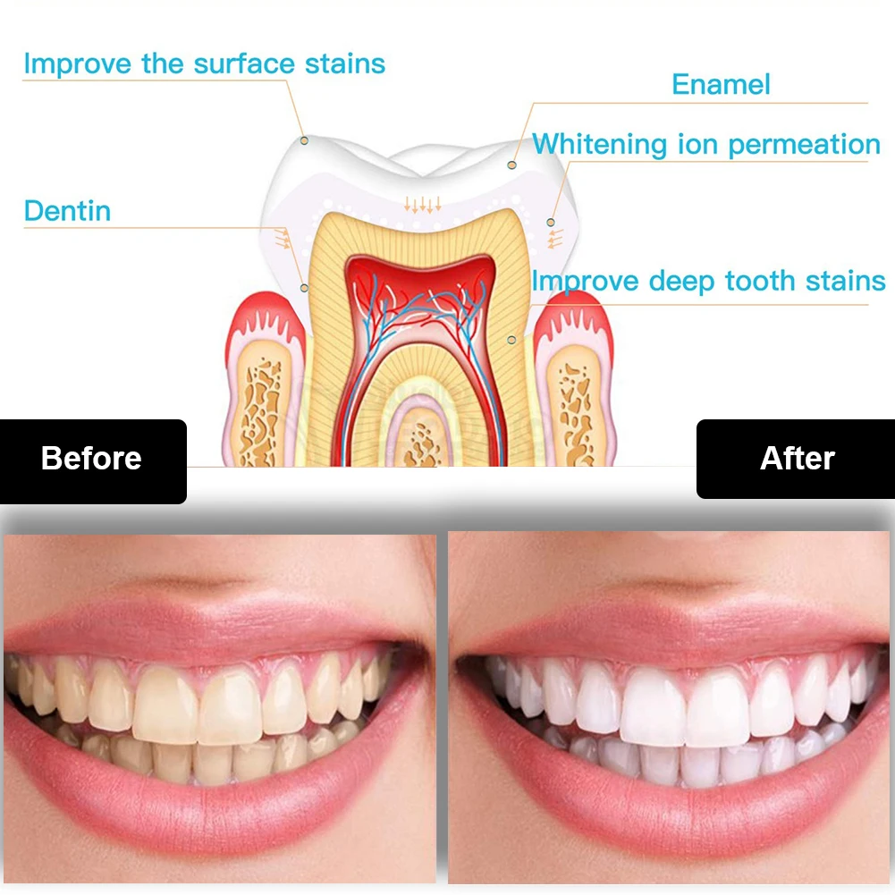 Dental Teeth Whitening Kit Min - Teeth Whitening For Trays recension och pris
